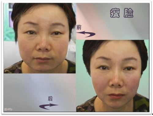 银针秀视频,揭秘传统中医针灸的神奇魅力